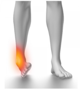 Ankle injury diagram